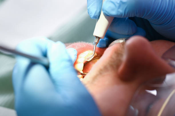 Best Emergency Root Canal Treatment in North Alamo, TX