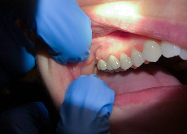 Best Emergency Dentist for Lost Fillings or Crowns in North Alamo, TX